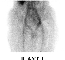 Bone Scan Blood Pool Phase 2